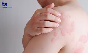 Triệu chứng ngứa nổi mề đay