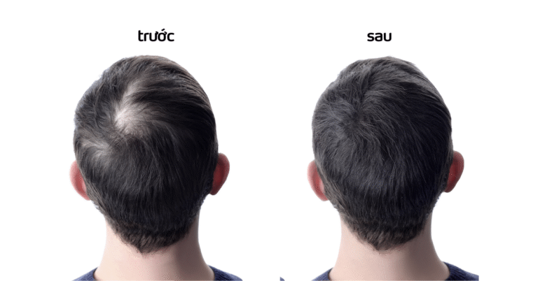 dầu gội thảo dược ngăn hói