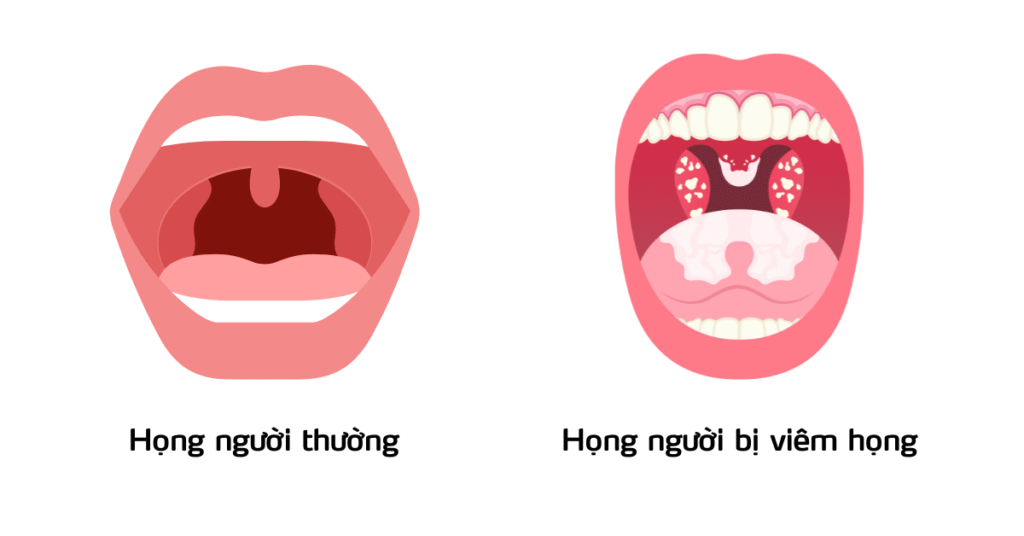 Tại Sao Cần Kháng Khuẩn Vùng Họng