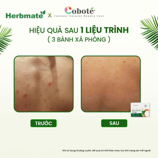 3 Xà Phòng Ngừa Mụn Cơ Thể Coboté 100g – Sạch Sâu, Mờ Thâm Và Phục Hồi Làn Da